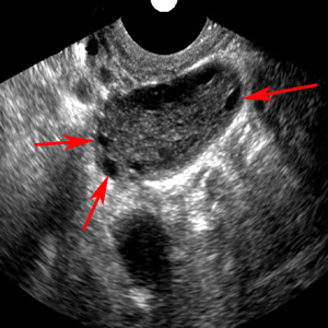 what is the meaning of pid in ultrasound